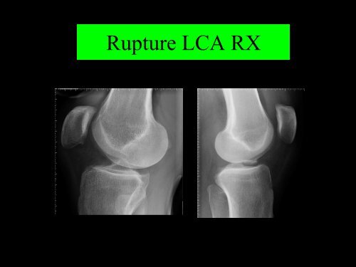 GENOU IMAGERIE LIGAMENTAIRE