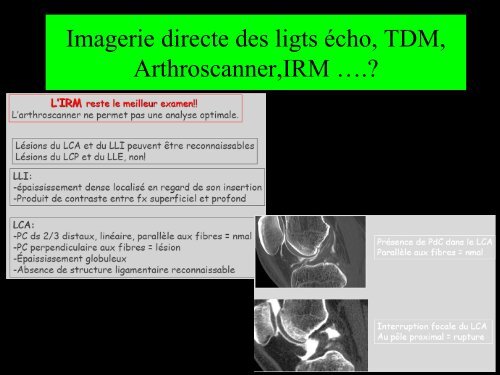 GENOU IMAGERIE LIGAMENTAIRE