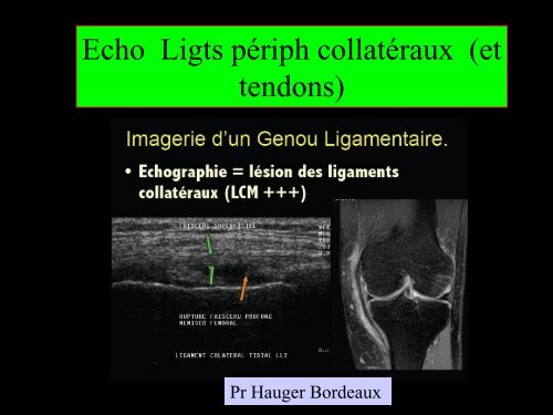 GENOU IMAGERIE LIGAMENTAIRE