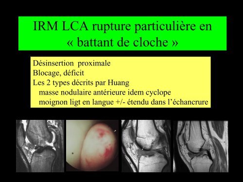 GENOU IMAGERIE LIGAMENTAIRE