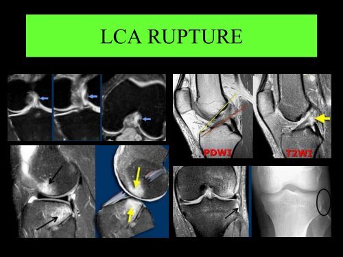 GENOU IMAGERIE LIGAMENTAIRE