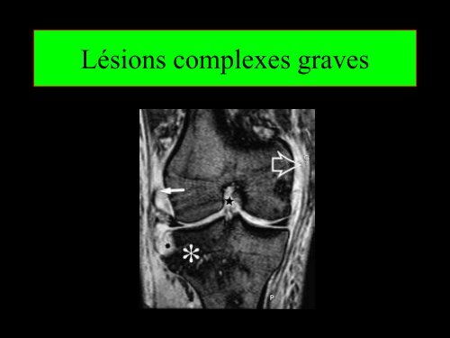 GENOU IMAGERIE LIGAMENTAIRE