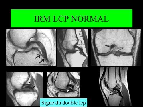 GENOU IMAGERIE LIGAMENTAIRE