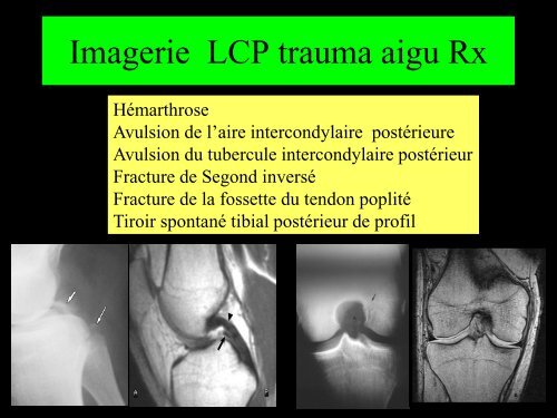 GENOU IMAGERIE LIGAMENTAIRE