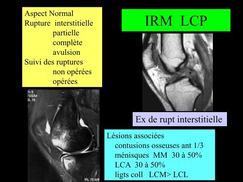 GENOU IMAGERIE LIGAMENTAIRE