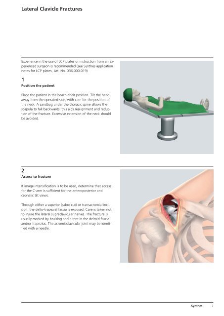 LCP Clavicle Hook Plate. The fixation system with ... - Osteosyntese