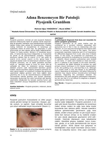 Adına Benzemeyen Bir Patoloji: Piyojenik Granülom - Yeni Tıp Dergisi
