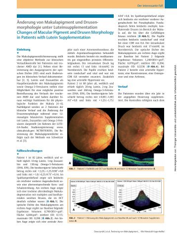 ÃƒÂ„nderung von Makulapigment und Drusenmorphologie unter ...