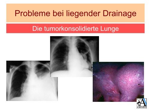 Probleme bei liegender Thoraxdrainage - Krankenhaus St ...