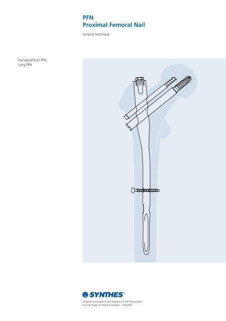 A succinct technique for the extraction of the proximal femoral nail  anti-rotation (PFNA) after unlocking failure: a case report | Journal of  Orthopaedic Surgery and Research | Full Text