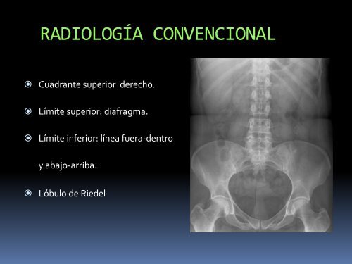 ANATOMÍA RADIOLÓGICA DEL HÍGADO