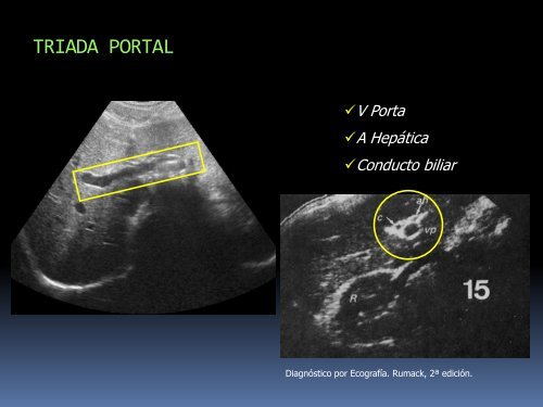 ANATOMÍA RADIOLÓGICA DEL HÍGADO