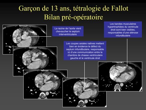 tomodensitometrie multicoupe et cardiopathies congenitales