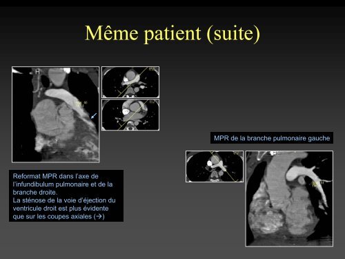 tomodensitometrie multicoupe et cardiopathies congenitales