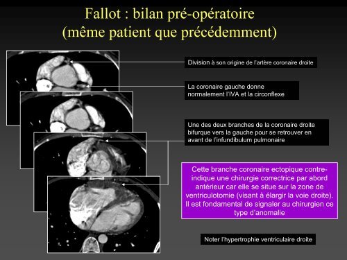 tomodensitometrie multicoupe et cardiopathies congenitales