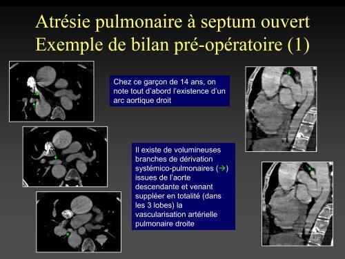 tomodensitometrie multicoupe et cardiopathies congenitales