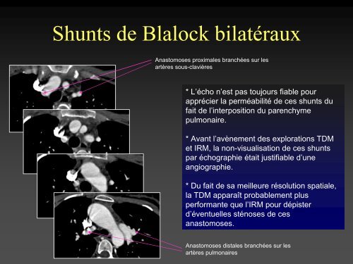 tomodensitometrie multicoupe et cardiopathies congenitales