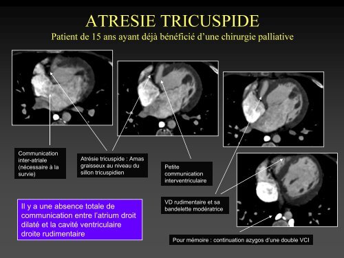 tomodensitometrie multicoupe et cardiopathies congenitales