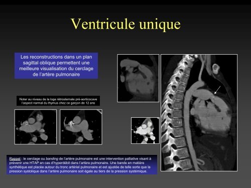 tomodensitometrie multicoupe et cardiopathies congenitales