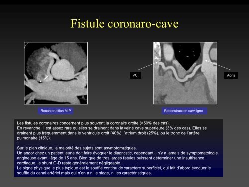 tomodensitometrie multicoupe et cardiopathies congenitales