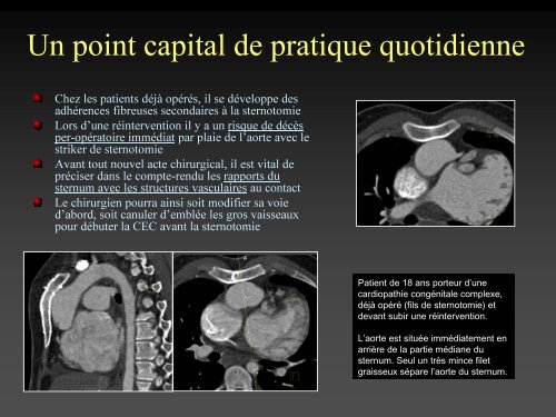 tomodensitometrie multicoupe et cardiopathies congenitales