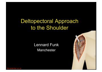 Deltopectoral Approach to the Shoulder - ShoulderDoc.co.uk
