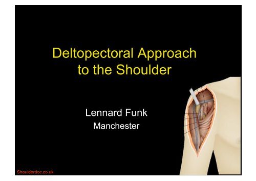 Deltopectoral Approach to the Shoulder - ShoulderDoc.co.uk