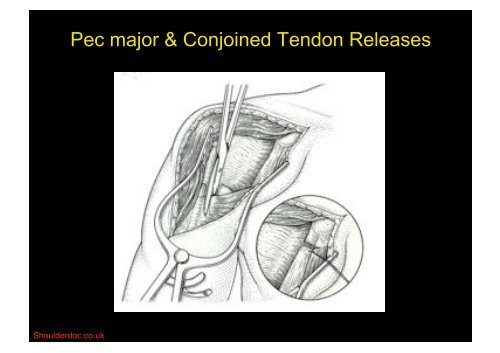 Deltopectoral Approach to the Shoulder - ShoulderDoc.co.uk