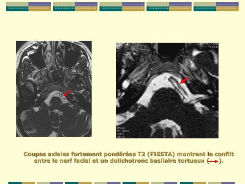 hemispasme facial et conflit neurovasculaire : apport de l'irm a ...