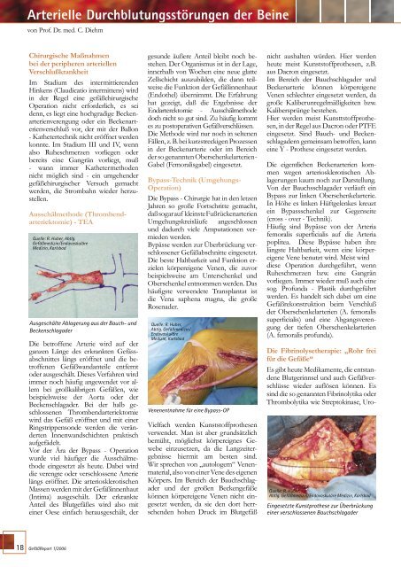 Arterielle DurchblutungsstÃ¶rungen der Beine - Deutsche GefÃ¤ÃŸliga eV