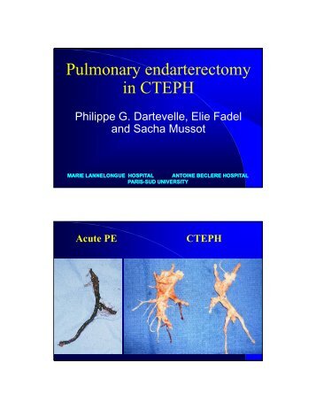 Pulmonary endarterectomy in CTEPH - RM Solutions