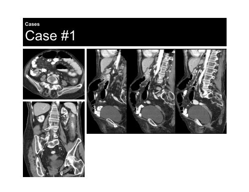 CT Imaging of Acute Bowel Ischemia and Infarction - Department of ...