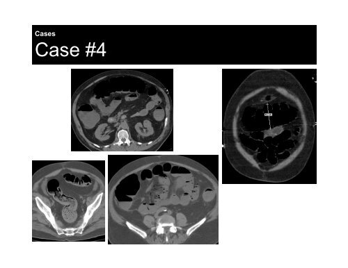 CT Imaging of Acute Bowel Ischemia and Infarction - Department of ...