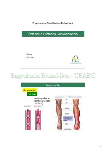Órteses e Próteses Convencionais - Engenharia Biomédica