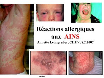 RÃ©actions allergiques aux AINS - CHUV