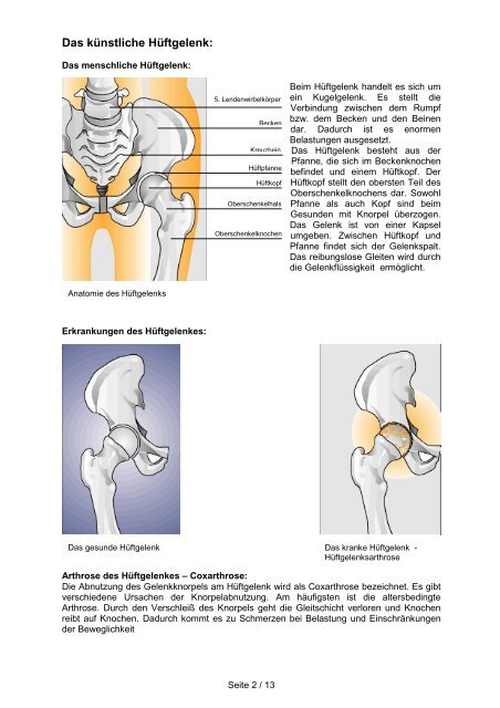 Das kÃ¼nstliche HÃ¼ftgelenk: - Klinikum Friedrichshafen GmbH