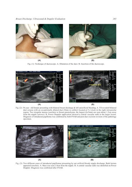 Breast Discharge: Ultrasound and Doppler Evaluation - NCI
