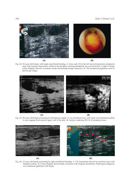 Breast Discharge: Ultrasound and Doppler Evaluation - NCI