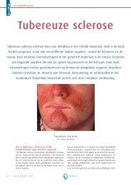 Tubereuze sclerose - Huid Magazine