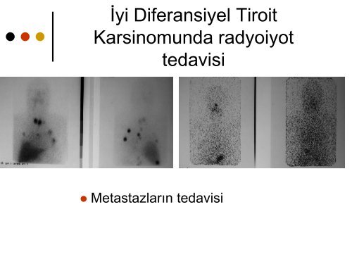 Hangi hastalar radyoaktif iyot tedavisine yÃ¶nlendirilmeli