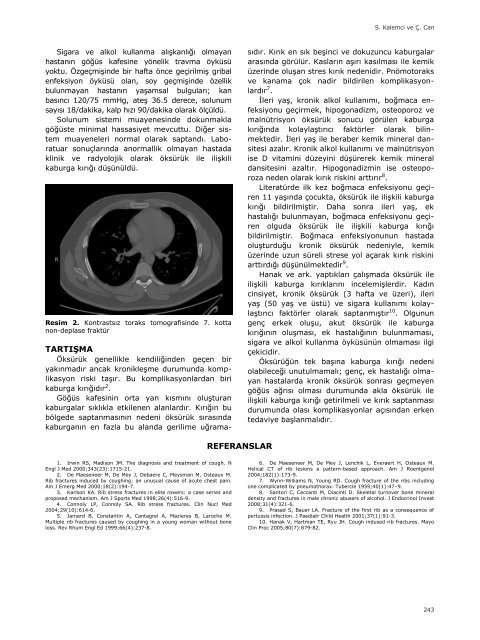 Öksürük İle İlişkili Kaburga Kırığı - Yeni Tıp Dergisi