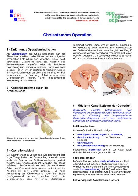 Cholesteatom Operation - Schweizerischen Gesellschaft für Oto ...