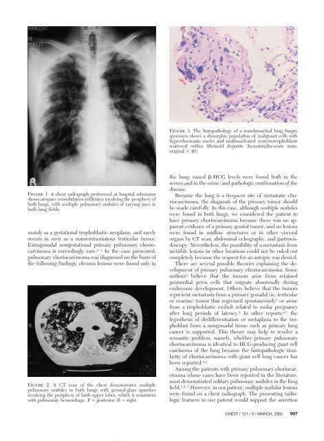 Use of Urine Pregnancy Test for Rapid Diagnosis of Primary ...