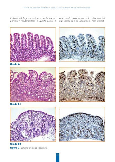 la malattia celiaca in medicina generale - Associazione Italiana ...