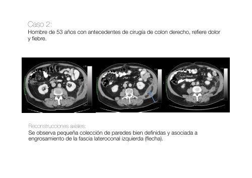 Valoración radiológica de las complicaciones más frecuentes, así ...