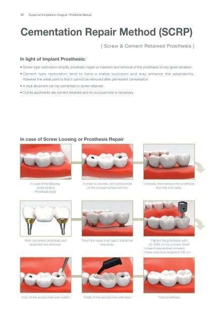 Dual Abutment