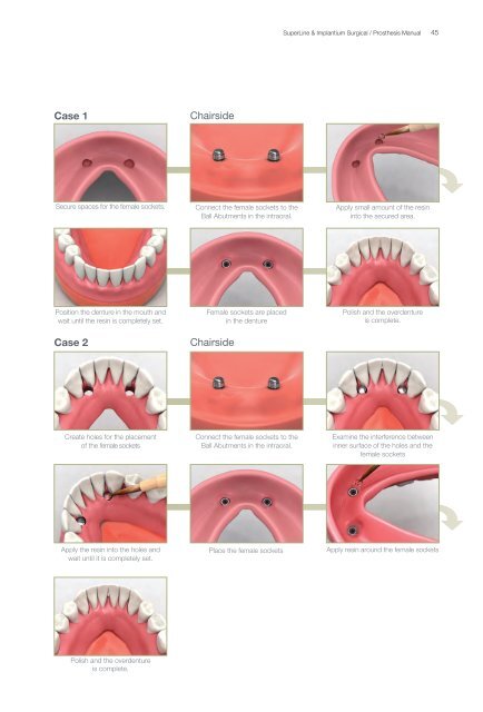 Dual Abutment