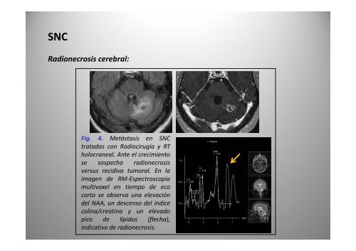 C bi d i Cambios secundarios a radioterapia: radioterapia: