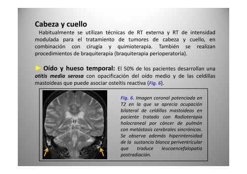 C bi d i Cambios secundarios a radioterapia: radioterapia: