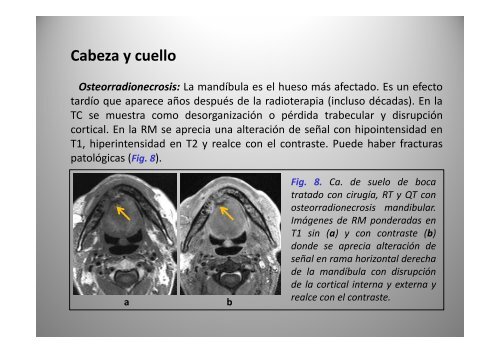 C bi d i Cambios secundarios a radioterapia: radioterapia: